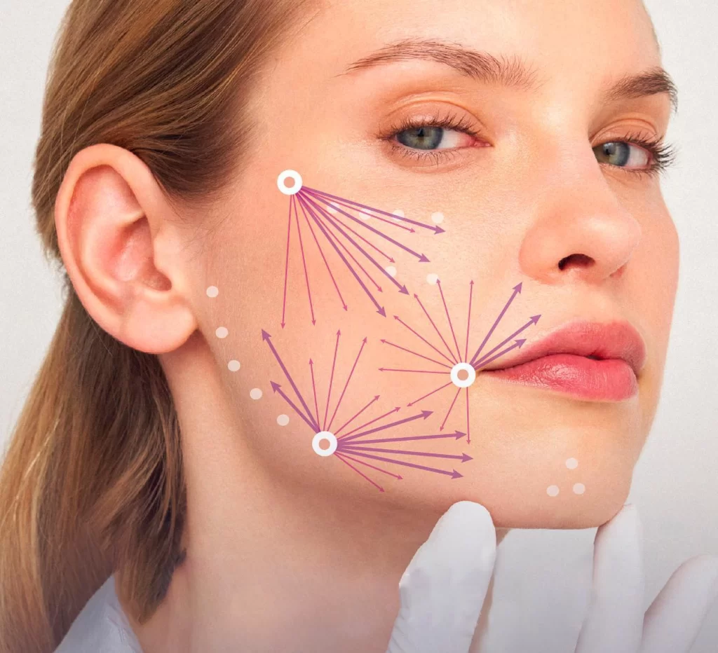 Visual explicativo da técnica MLT 3.1 aplicada no tratamento facial com Teoxane.